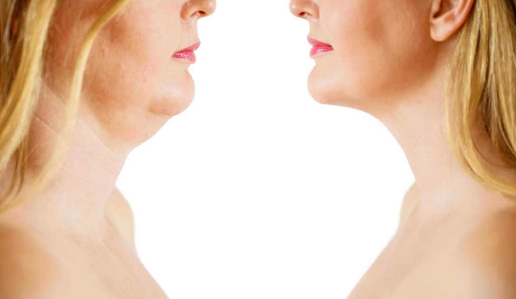Double Chin treatment Waltham Forest before and after results
