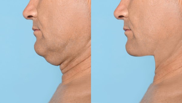 Which Non-Surgical Treatments Work Best for Jowls and Loose Skin Waltham Forest?