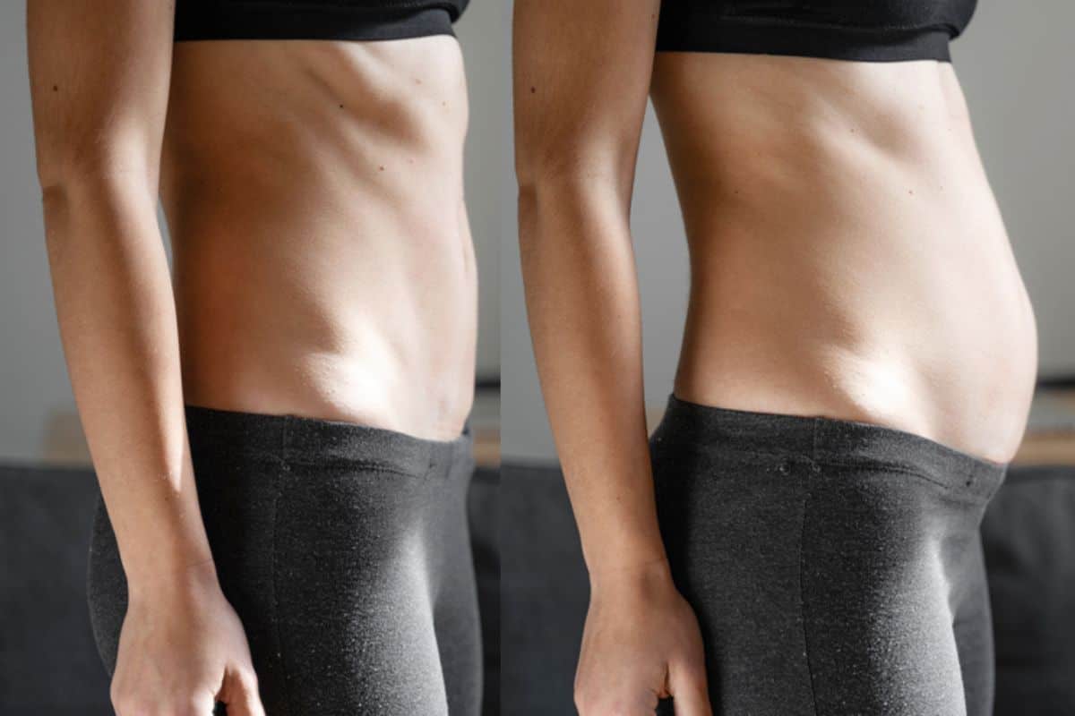How long does diastasis recti take to improve Waltham Forest?