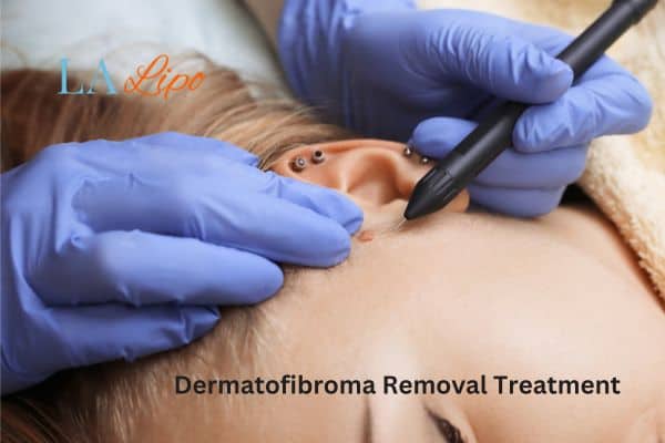 Dermatofibroma Removal Treatment Waltham Forest
