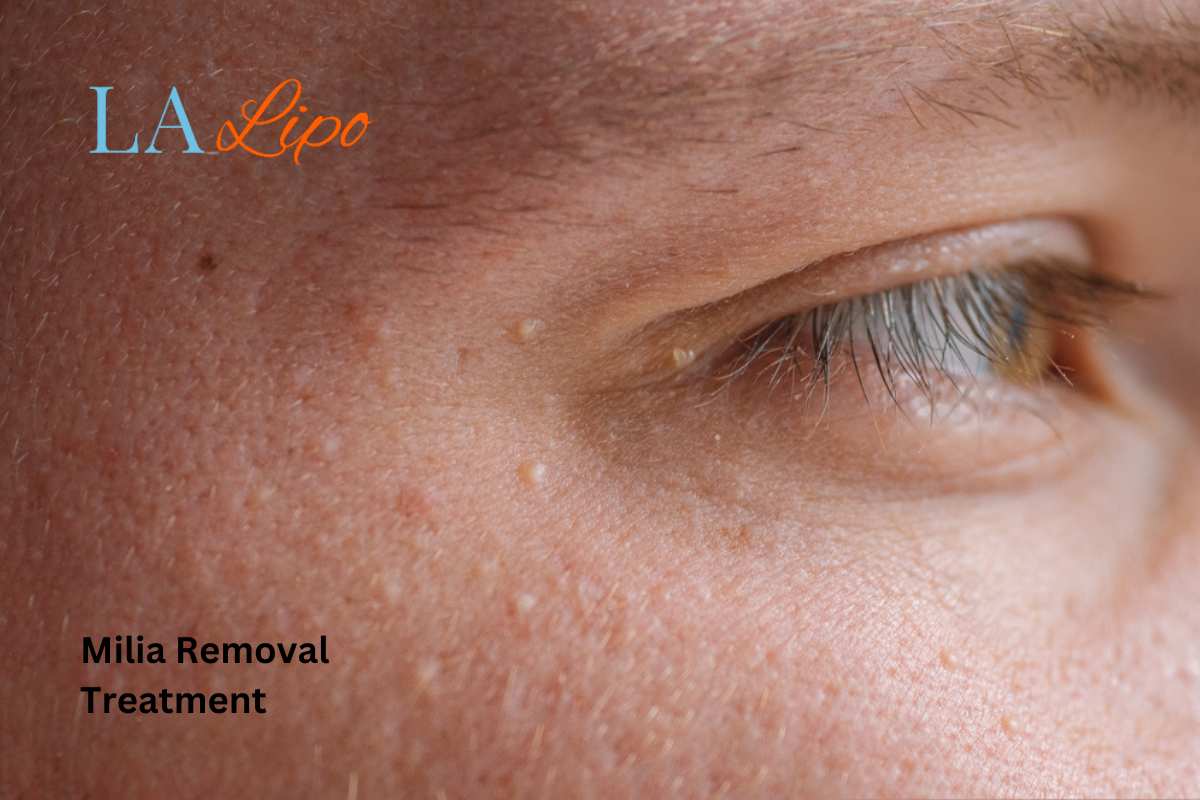 Cryopen Milia Removal: Is It the Easiest and Safest Option Waltham Forest?