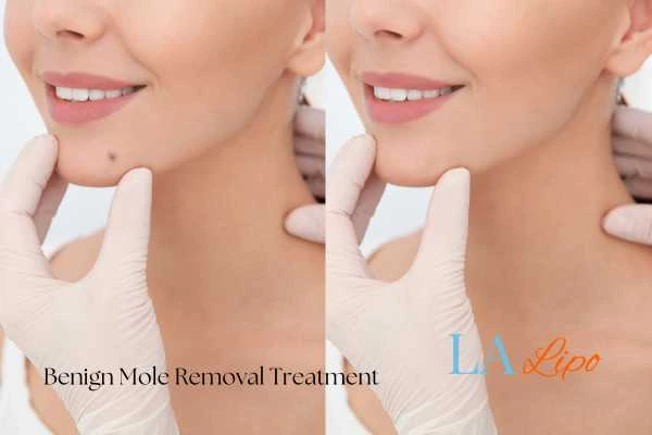woman's before and after mole removal Waltham Forest results