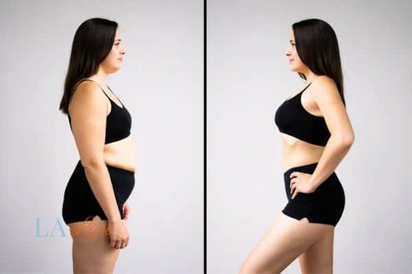 image of woman before and after results of LA-EMS Body Sculpting Waltham Forest to help treat Diastasis recti