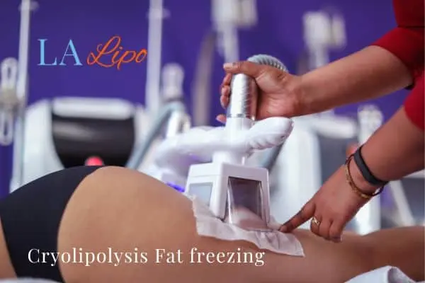 women getting fat freezing Waltham Forest