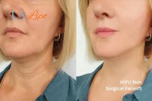 hi-fu for wrinkles Waltham Forest before and after results