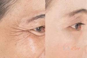 Before and after results of woman - HI-fu wrinkles reduction treatment Waltham Forest