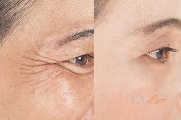 Before and after results of woman - HI-fu wrinkles reduction treatment Waltham Forest