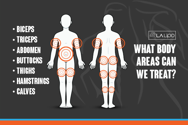 Graphic to show areas you can have LA-EMS Body Sculpting Waltham Forest treatment.