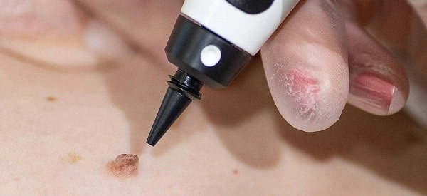 skin tag removal using cryopen Waltham Forest