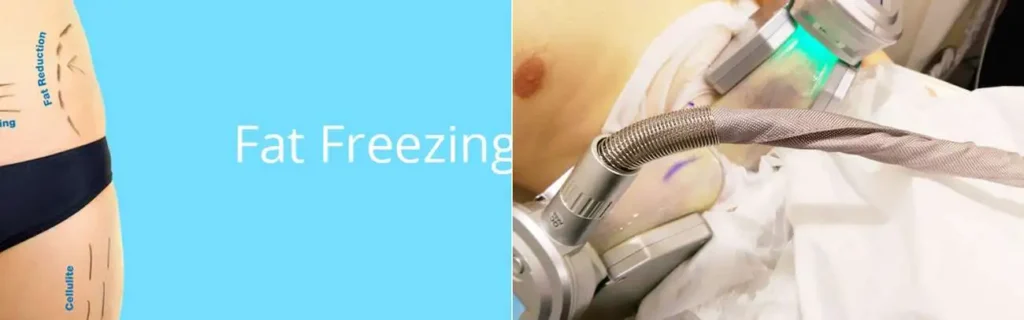 Fat freezing Waltham Forest on multiple areas of the body