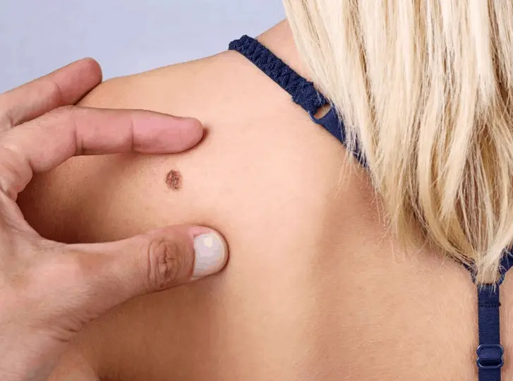 woman having mole removal Waltham Forest consultation before treatment.