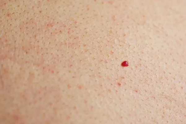 close up of a cherry angioma Waltham Forest