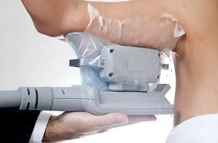 Picture of fat freezing Waltham Forest on the upper arms.