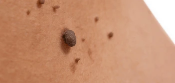 image of a skin tag Waltham Forest