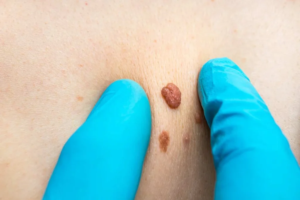 Consultant examining a skin tag Waltham Forest