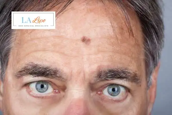 Solar Lentigo Removal Waltham Forest image of man with mark on his forehead
