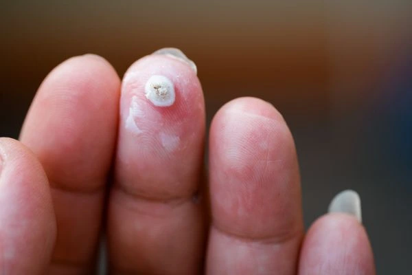 wart on person finger - cryotherapy to treat from LA LIPO Waltham Forest