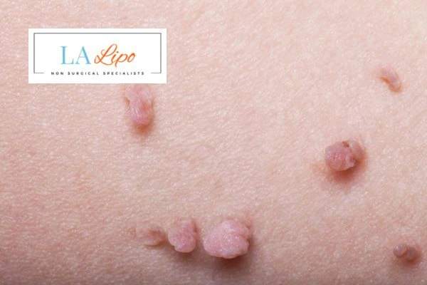 Does cryopen skin tag removal Waltham Forest hurt? Find out now call our team today!