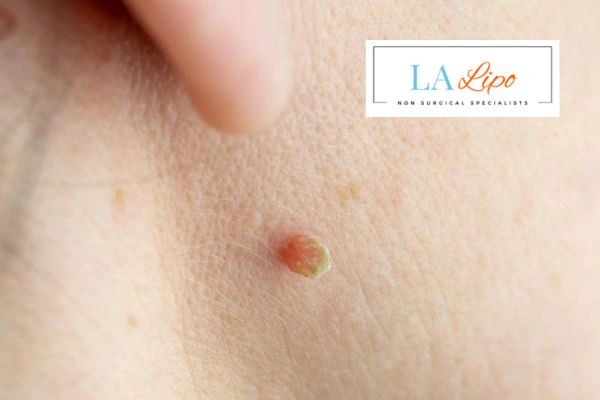Book skin tag removal Waltham Forest today speak to our team now!