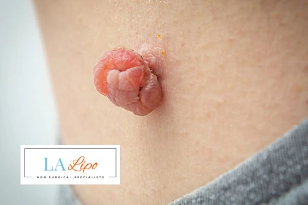 Interested in skin tag removal Waltham Forest? Concerned about the pain? Find out more today!