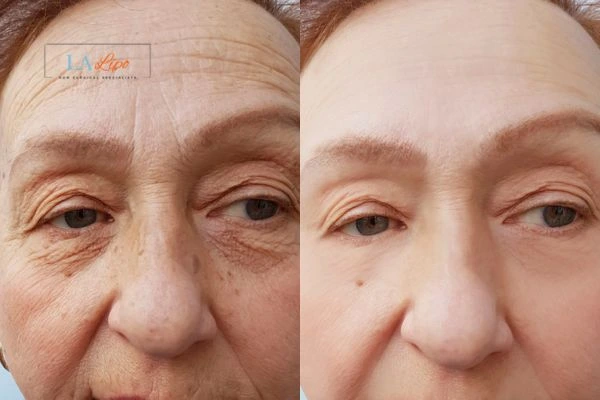 The powerful benefits of Morpheus8 Treatment Waltham Forest - Call Our team today!