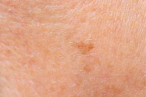 close up picture of age spots Waltham Forest