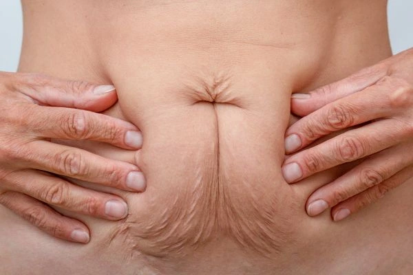 Should I Combine Diastasis Recti Treatment with Body Contouring for Better Results Waltham Forest?