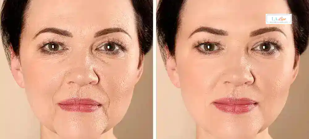 How Long Does It Take to See Results and How Long Do They Last Waltham Forest?