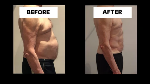 What Symptoms Can Diastasis Recti Cause in Men? Weak Core, Back Pain and Poor Posture Waltham Forest